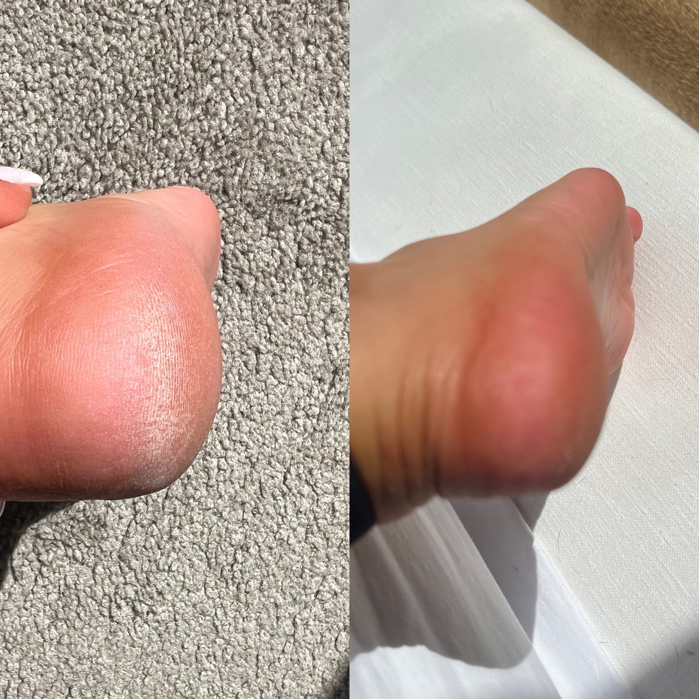 comparison of dry rough heel to smooth minutes later after using foot file